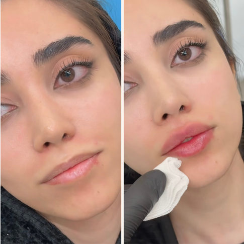 Dermal Fillers